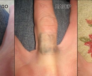 вывести наколку фотографии до и после как удалить татуировку