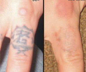 удаление татуировки лазером на пальце перстень до и после