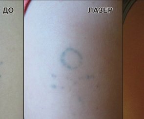 выведение татуировок киев результат фотографии