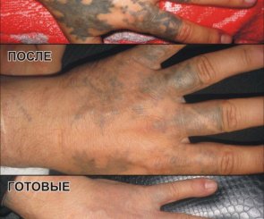 вывести наколку партак лазером фото до и после