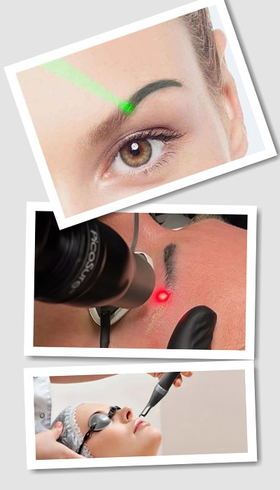 Як Видалити татуаж у Києві