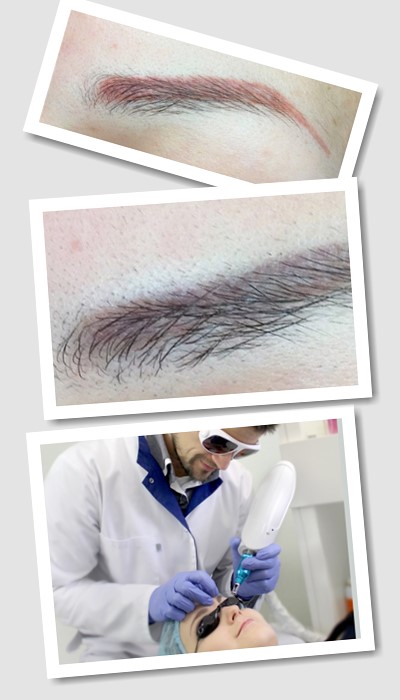 Як видаляють татуаж