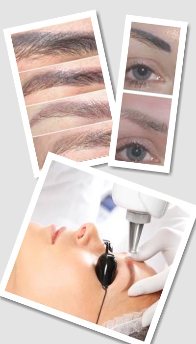 Як Видалити татуаж у Києві