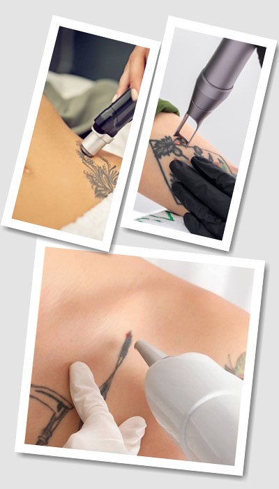 Виведення тату