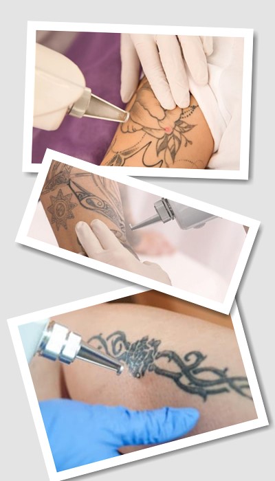 Виведення тату