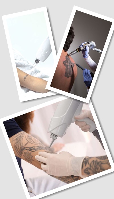 Виведення тату лазером