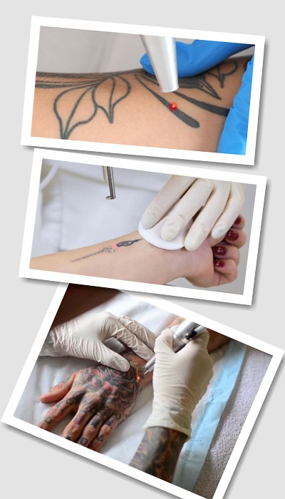 Виведення тату лазером