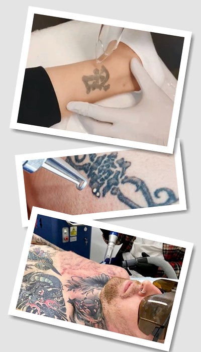 Видалити тату на обличчі