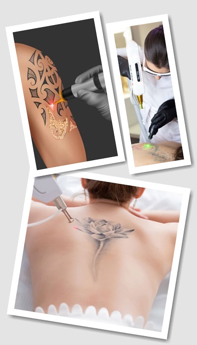 Видалити тату у Києві