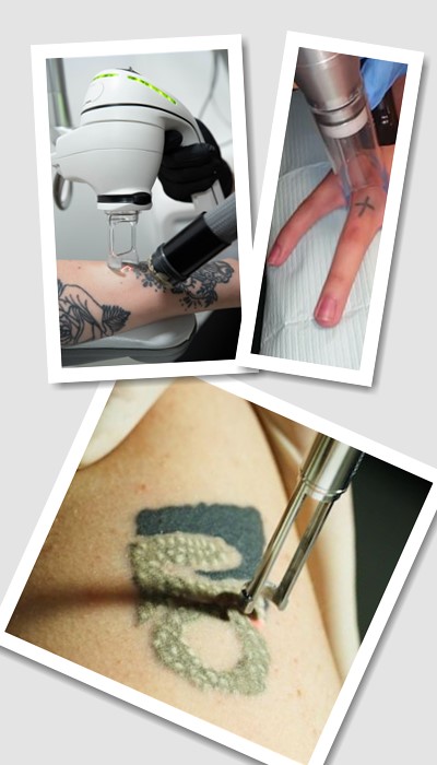 Видалити тату лазером у Києві