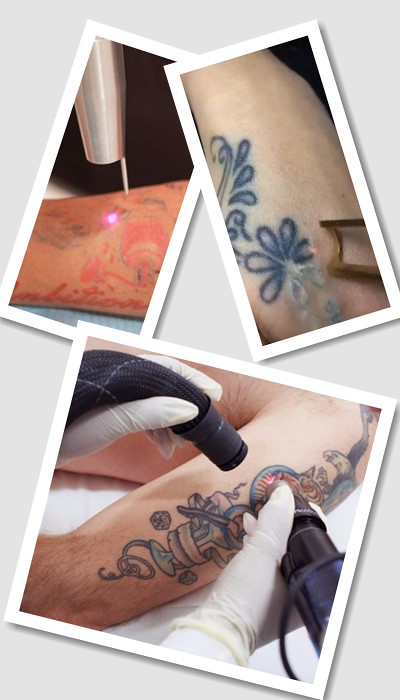 Як Видалити тату