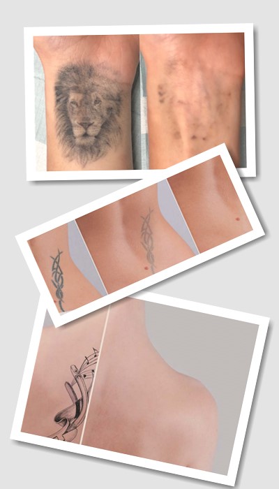 Як Видалити тату у Києві