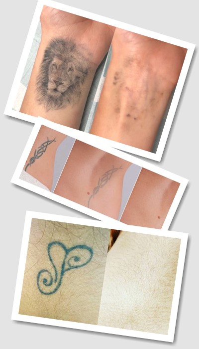 Як видаляють тату