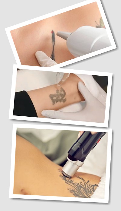 Виведення тату лазером