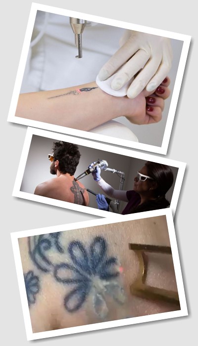 Виведення татуювання лазером