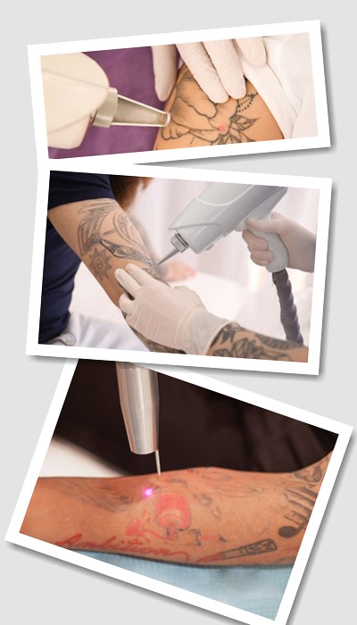 Видалити тату лазером