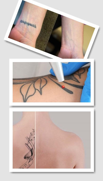 Видалити тату у Києві