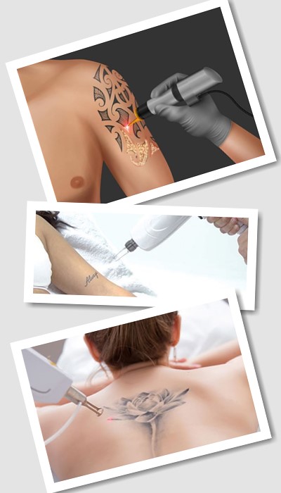 Видалити тату лазером у Києві