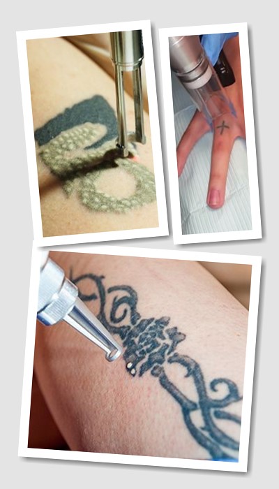 Як Видалити тату