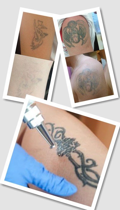 Як Видалити тату у Києві