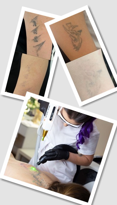 Виведення тату