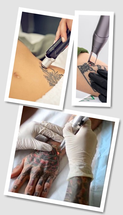 Виведення тату ремувером