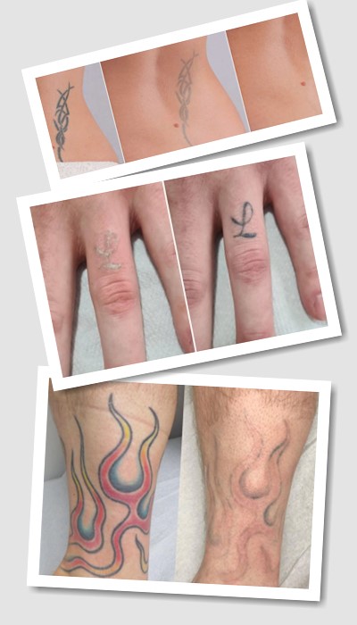 Виведення татуювання ремувером