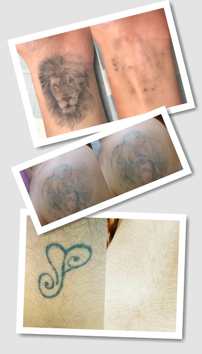 Видалити тату ремувером