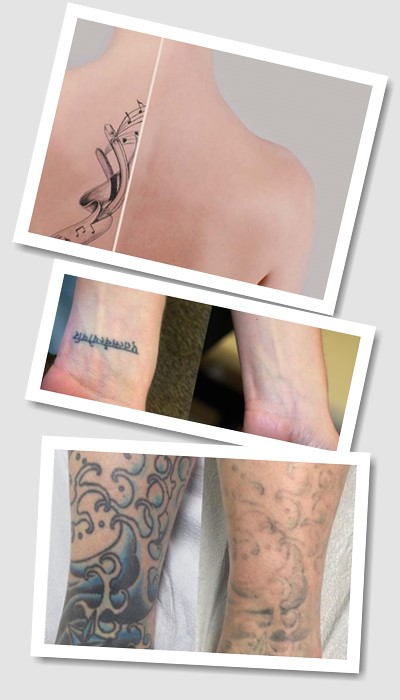 Видалити тату у Києві