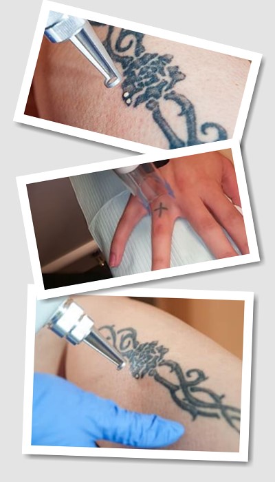 Видалити тату ремувером у Києві