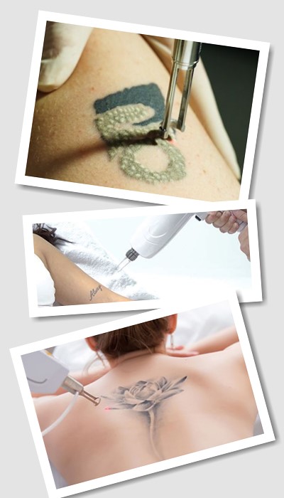 Як Видалити тату