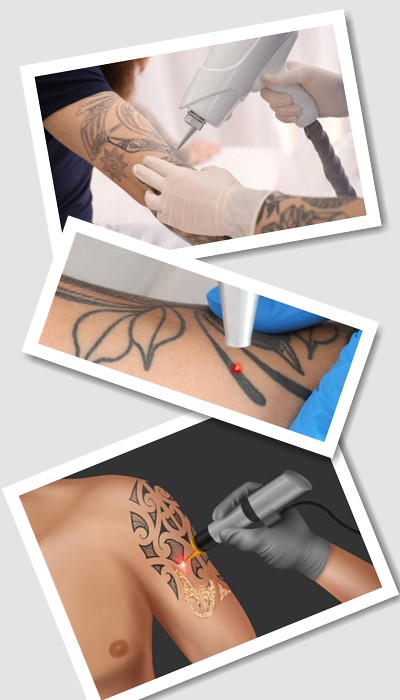 Як Видалити тату у Києві