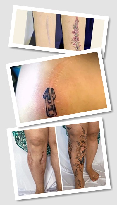 Маскування шрамів за допомогою татуювання
