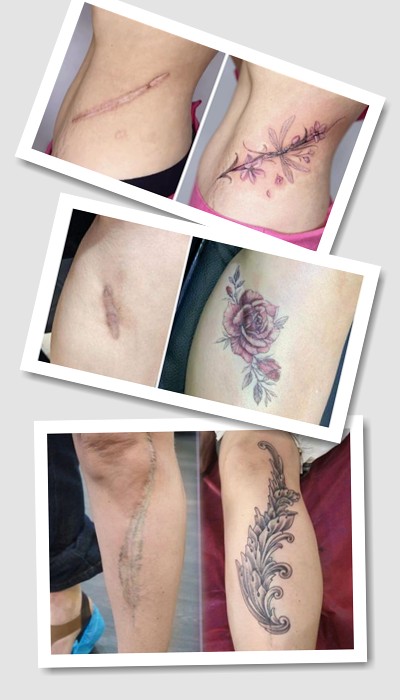 Маскування шрамів за допомогою тату